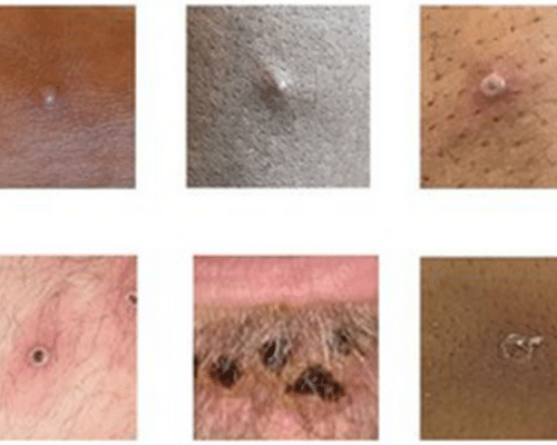 Pictures of monkeypox - Drlogy