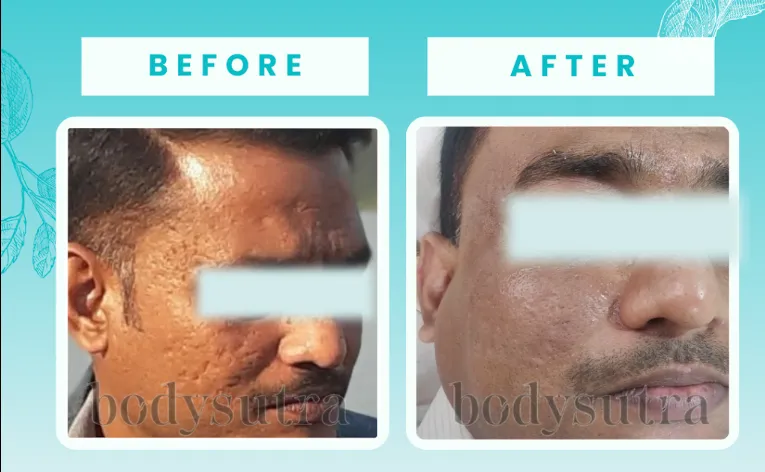 Bodysutra Clinique - Skin & Hair Clinic Images/Photos, Pimpri Chinchwad, Pune