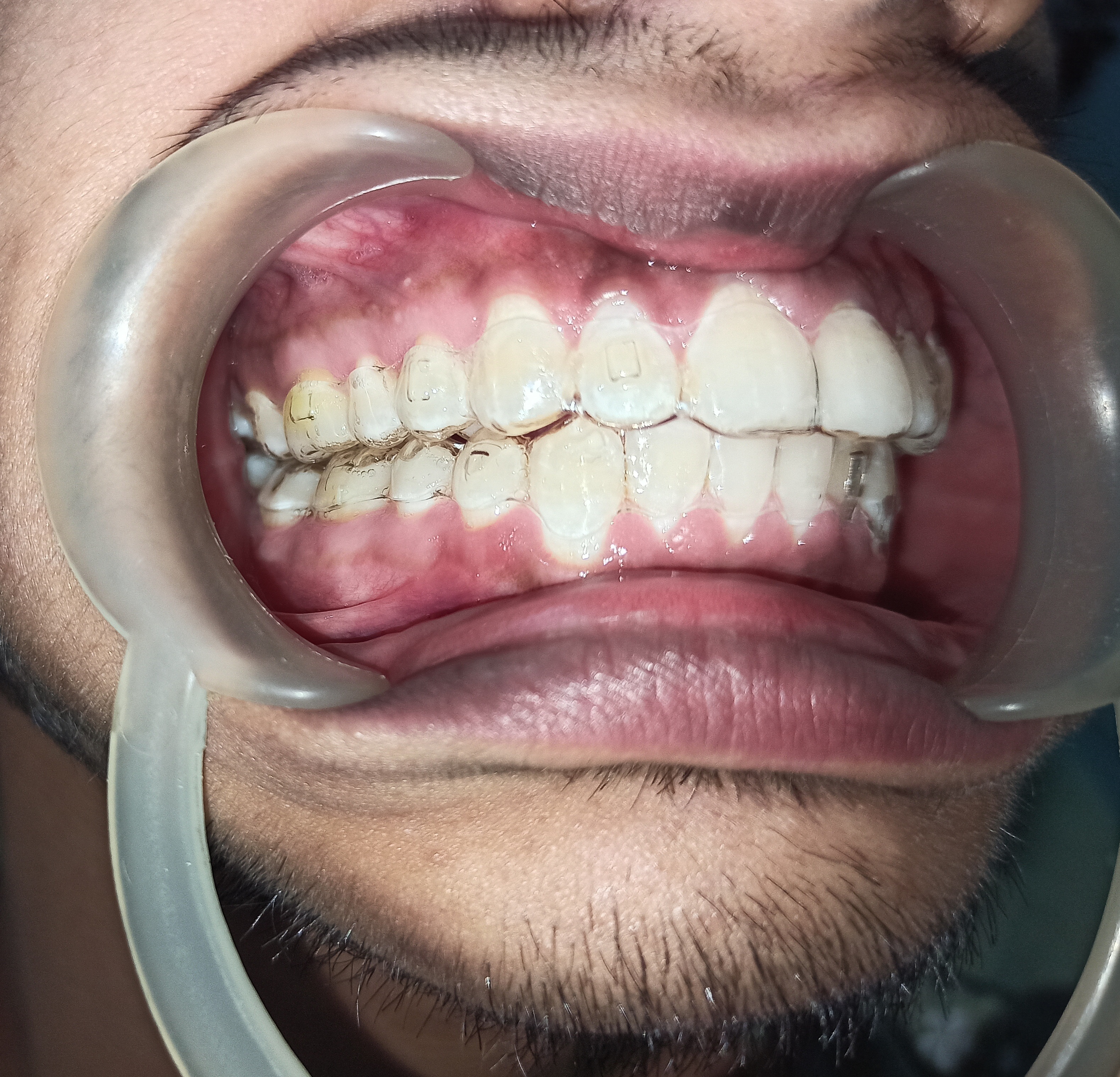 Professional Aligners - Invisible Braces At Patna Images/Photos, Ramkrishna Nagar, Patna