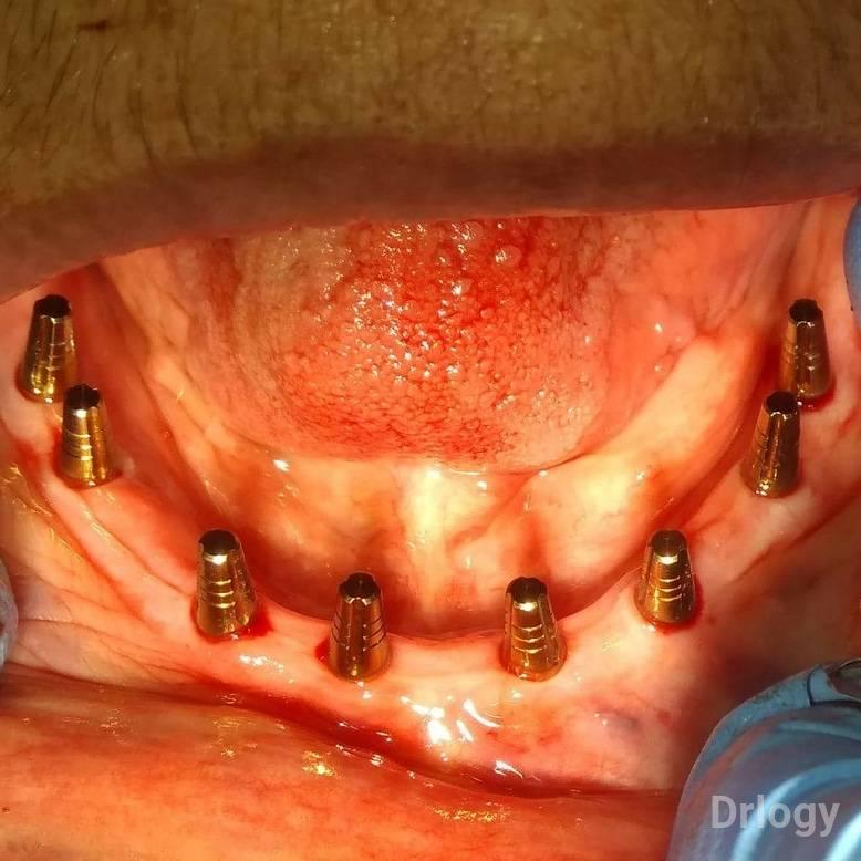 Aashirwad Dental implant & cosmetic rehabilitation centre in Rajkot Aashirwad Dental implant & cosmetic rehabilitation centre in Rajkot